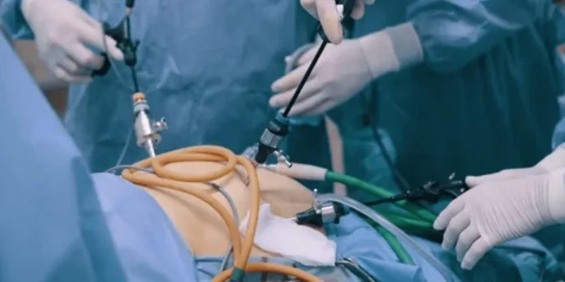 Gallbladder Surgery